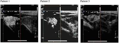 Application of Preoperative Ultrasonography in the Diagnosis of Cervical Lymph Node Metastasis in Thyroid Papillary Carcinoma